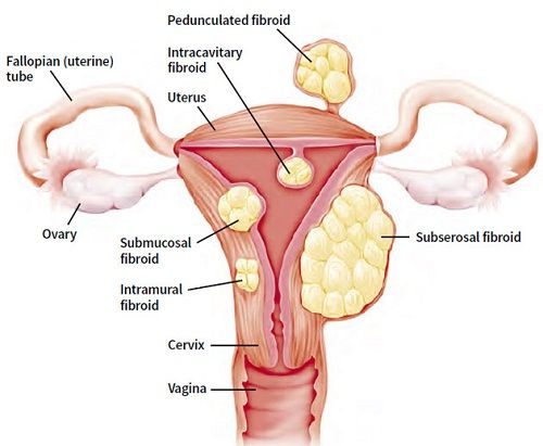 Uterine fibroids
